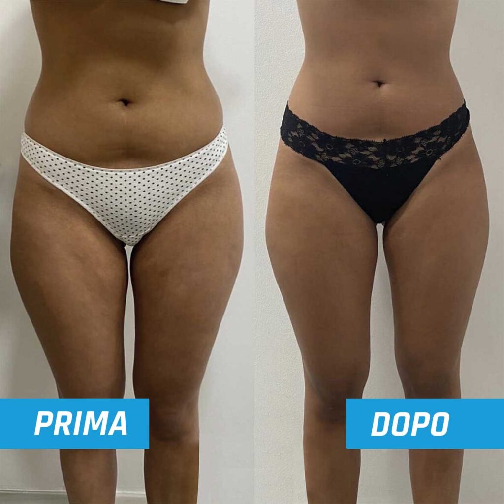 prima-dopo-1